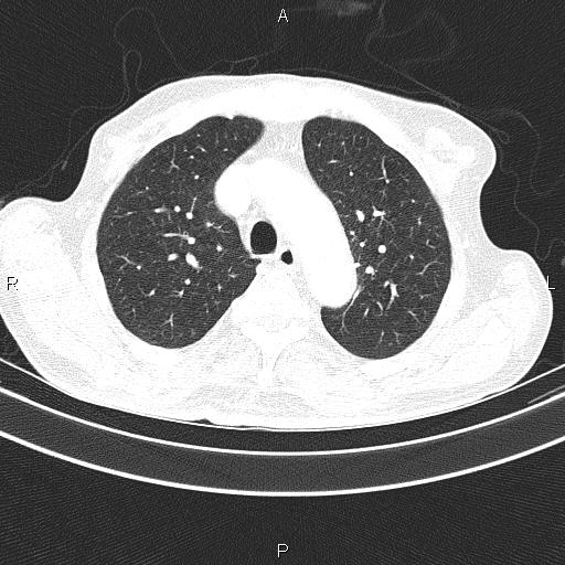 Ampullary adenocarcinoma (Radiopaedia 86093-102033 Axial lung window 23).jpg