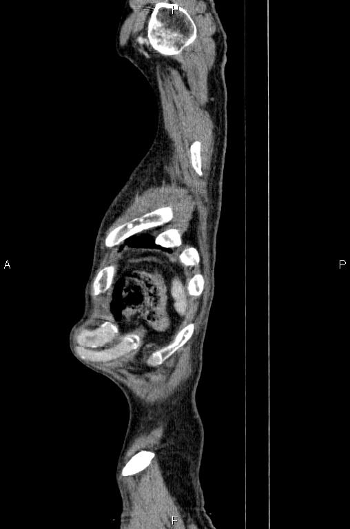 Ampullary adenocarcinoma (Radiopaedia 86093-102033 E 91).jpg