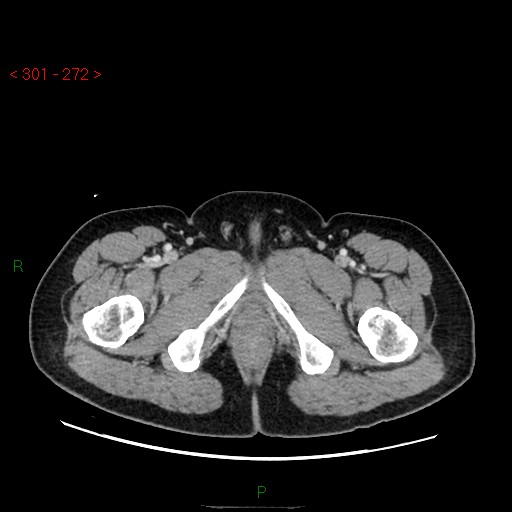 File:Ampullary carcinoma (Radiopaedia 56396-63056 C 109).jpg