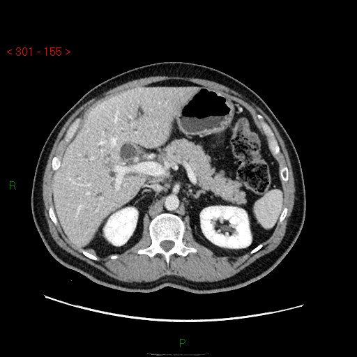 Ampullary carcinoma (Radiopaedia 56396-63056 C 31).jpg