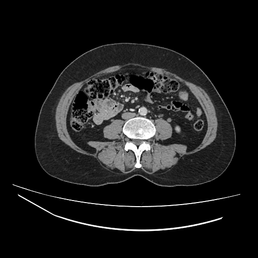 Ampullary tumor (Radiopaedia 60333-67998 A 47).jpg