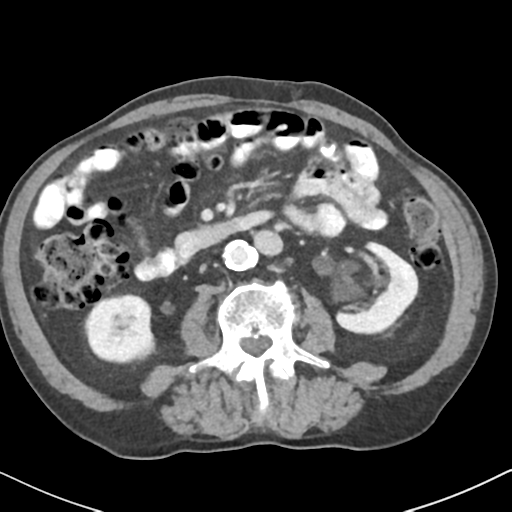File:Amyand hernia (Radiopaedia 39300-41547 A 32).png