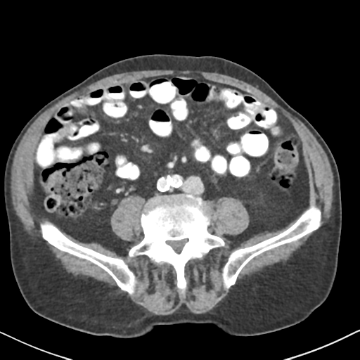File:Amyand hernia (Radiopaedia 39300-41547 A 43).png