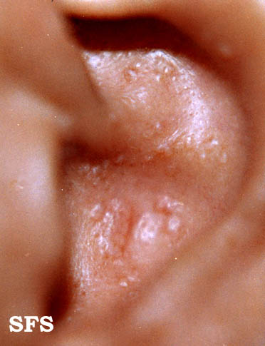 File:Amyloidosis (Dermatology Atlas 2).jpg