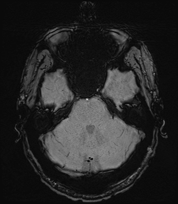 Amyotrophic lateral sclerosis (Radiopaedia 87352-103658 Axial SWI 11).jpg