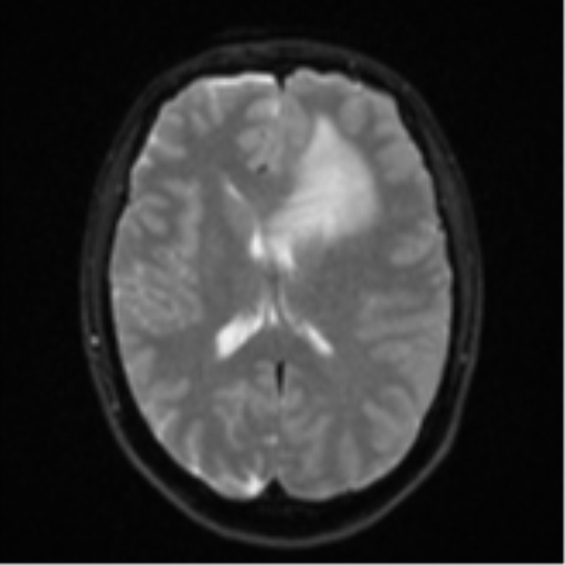 Anaplastic astrocytoma (Radiopaedia 57768-64731 Axial DWI 16).png