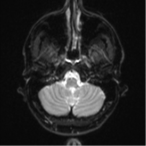 Anaplastic astrocytoma (Radiopaedia 57768-64731 Axial DWI 4).png