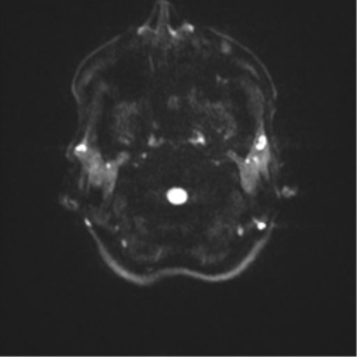 Anaplastic astrocytoma IDH mutant (Radiopaedia 50046-55341 Axial DWI 28).png