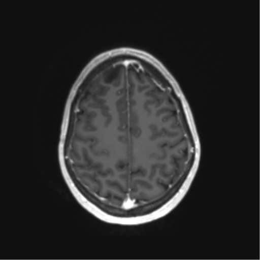 File:Anaplastic astrocytoma IDH mutant (Radiopaedia 50046-55341 Axial T1 C+ 39).png