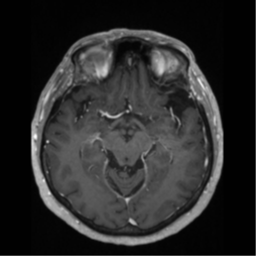 File:Anaplastic astrocytoma IDH wild-type (pseudoprogression) (Radiopaedia 42209-45276 Axial T1 C+ 65).png