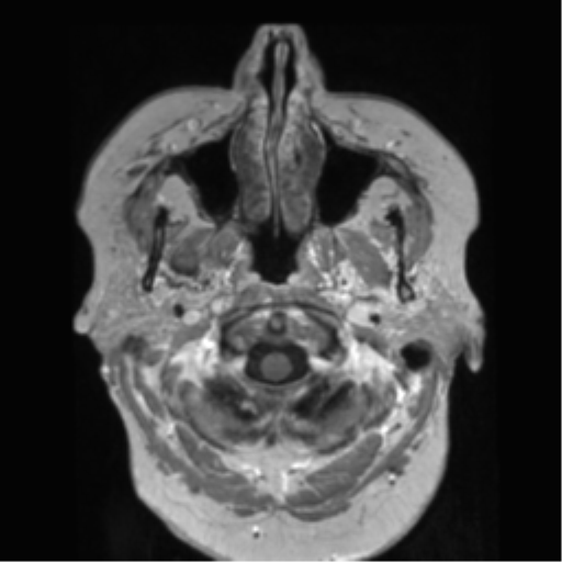 File:Anaplastic astrocytoma IDH wild-type (pseudoprogression) (Radiopaedia 42209-45278 Axial T1 C+ 20).png