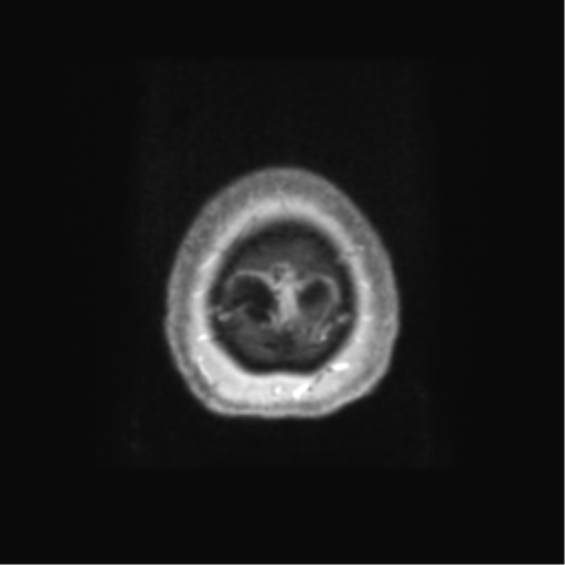 Anaplastic astrocytoma IDH wild-type (pseudoprogression) (Radiopaedia 42209-45279 Axial T1 C+ 139).png