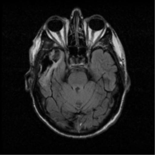 File:Anaplastic meningioma with recurrence (Radiopaedia 34452-35789 Axial FLAIR 8).png