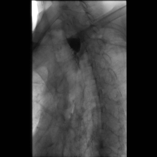 File:Anastomotic stricture post Ivor Lewis esophagectomy (Radiopaedia 47937-52715 Oblique 4).png