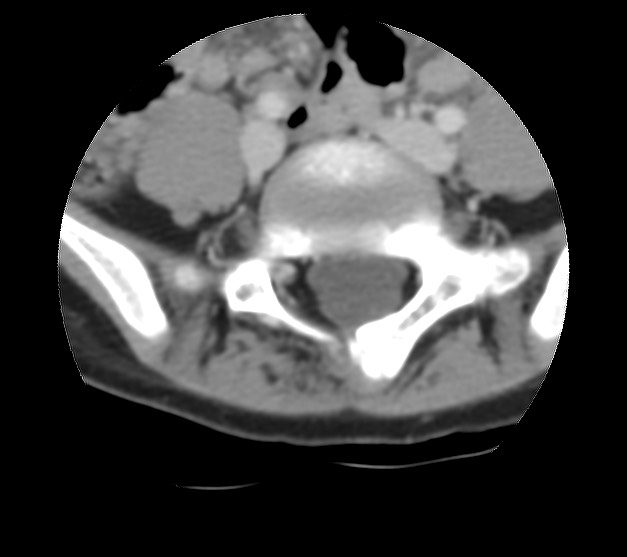 Aneurysmal bone cyst - sacrum (Radiopaedia 65190-74195 Axial non-contrast 14).jpg