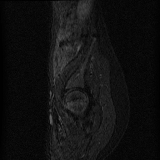 File:Aneurysmal bone cyst - sacrum (Radiopaedia 65190-74196 Sagittal STIR 5).jpg