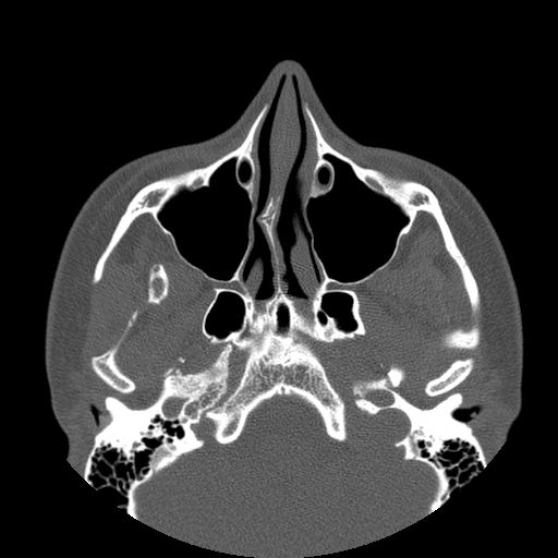 Aneurysmal bone cyst of the mandible (Radiopaedia 43280-46823 Axial bone window 137).jpg