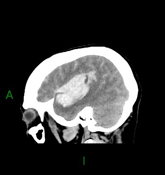 File:Aneurysmal subarachnoid hemorrhage with intra-axial extension (Radiopaedia 84371-99699 B 11).jpg
