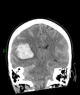 Aneurysmal subarachnoid hemorrhage with intra-axial extension (Radiopaedia 84371-99699 Coronal non-contrast 31).jpg