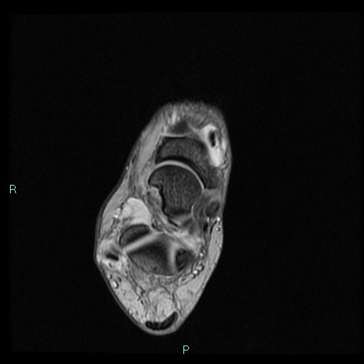 Ankle ganglion cyst (Radiopaedia 62809-71162 Axial Gradient Echo 42).jpg