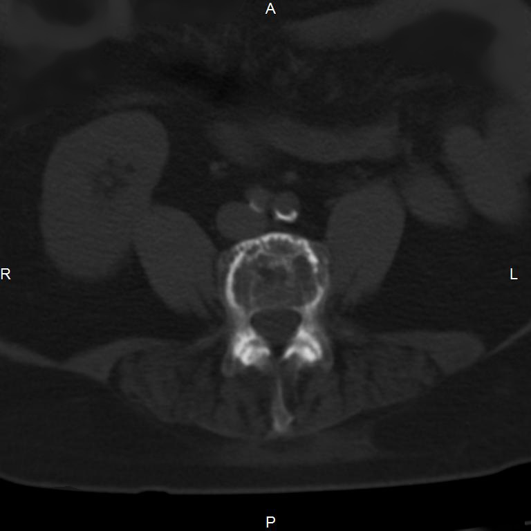 Ankylosing spondylitis (Radiopaedia 8748-9556 Axial bone window 37).jpg