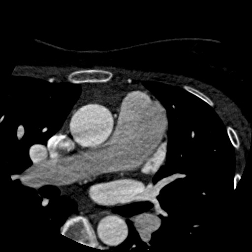 Anomalous left coronary artery from the pulmonary artery (ALCAPA) (Radiopaedia 40884-43586 A 4).jpg