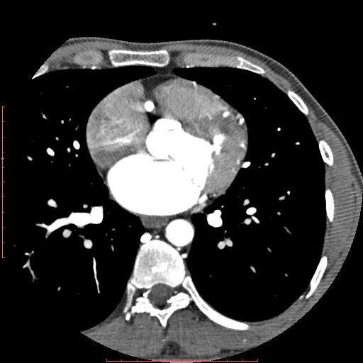 File:Anomalous left coronary artery from the pulmonary artery (ALCAPA) (Radiopaedia 70148-80181 A 165).jpg