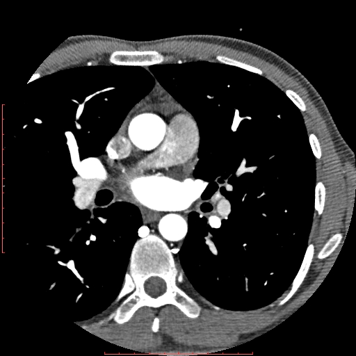 Anomalous left coronary artery from the pulmonary artery (ALCAPA) (Radiopaedia 70148-80181 A 36).jpg