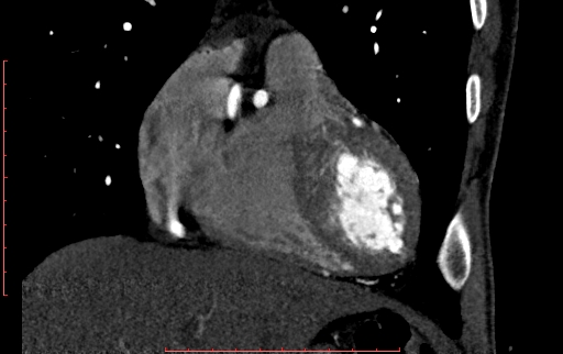 Anomalous left coronary artery from the pulmonary artery (ALCAPA) (Radiopaedia 70148-80181 B 87).jpg