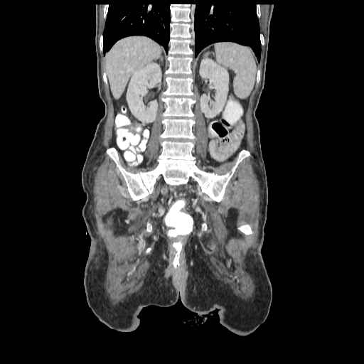 Anorectal carcinoma (Radiopaedia 44413-48064 B 58).jpg