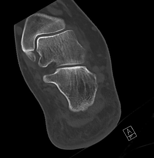 File:Anterior calcaneal process fracture (Radiopaedia 63353-71943 Axial bone window 103).jpg