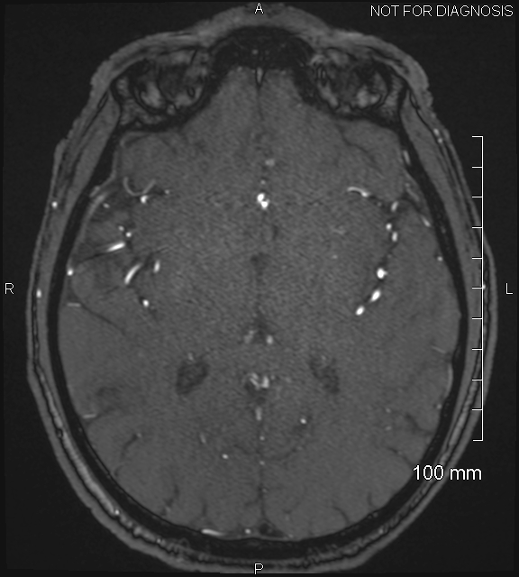 Anterior cerebral artery aneurysm (Radiopaedia 80683-94127 Axial MRA 129).jpg