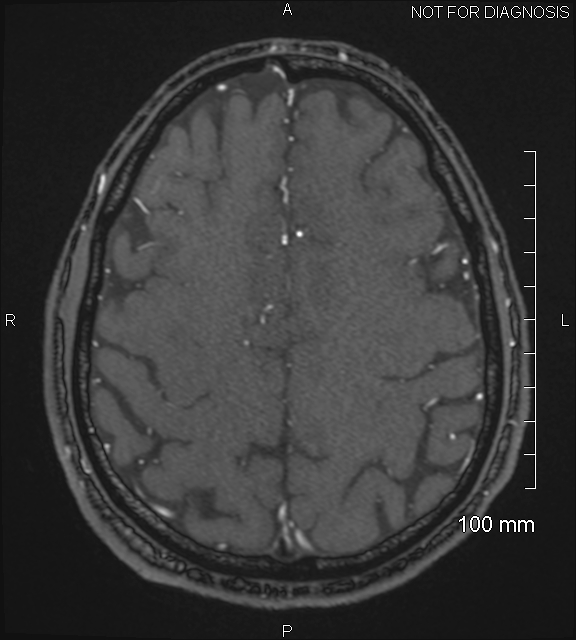 Anterior cerebral artery aneurysm (Radiopaedia 80683-94127 Axial MRA 194).jpg