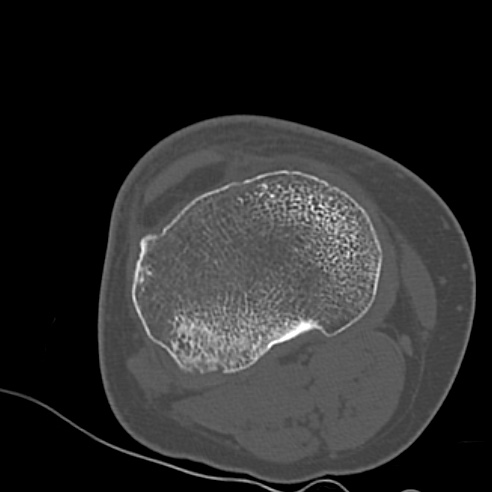 File:Anterior cruciate ligament avulsion fracture (Radiopaedia 58939-66194 Axial bone window 21).jpg
