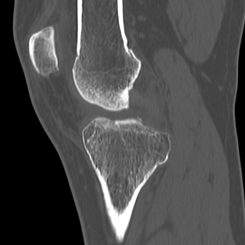 File:Anterior cruciate ligament avulsion fracture (Radiopaedia 58939-66194 Sagittal bone window 25).jpg