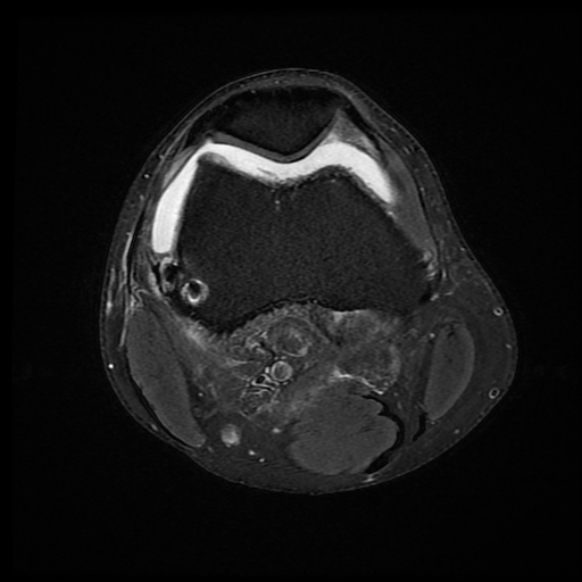 File:Anterior cruciate ligament graft tear and bucket-handle tear of medial meniscus (Radiopaedia 75867-87255 Axial PD fat sat 18).jpg
