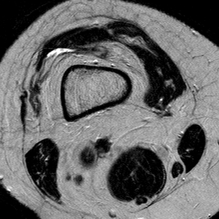 File:Anterior cruciate ligament mucoid degeneration (Radiopaedia 60853-68633 Axial T2 29).jpg