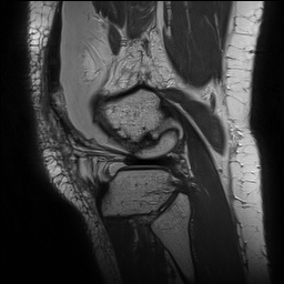 Anterior cruciate ligament rupture with Segond fracture (Radiopaedia 69043-78806 Sagittal PD 150).jpg