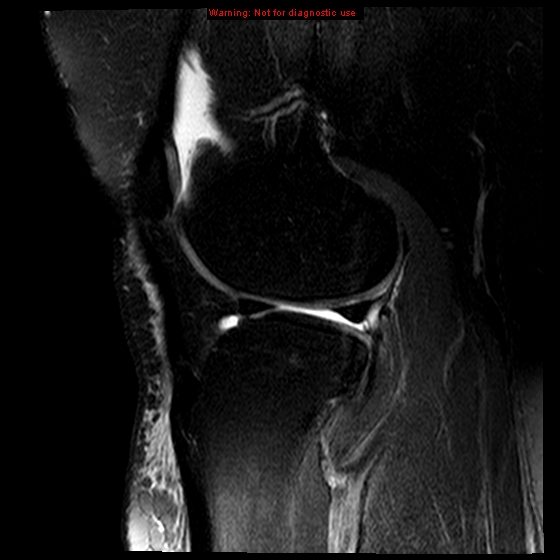 File:Anterior cruciate ligament tear (Radiopaedia 12329-12612 E 6).jpg