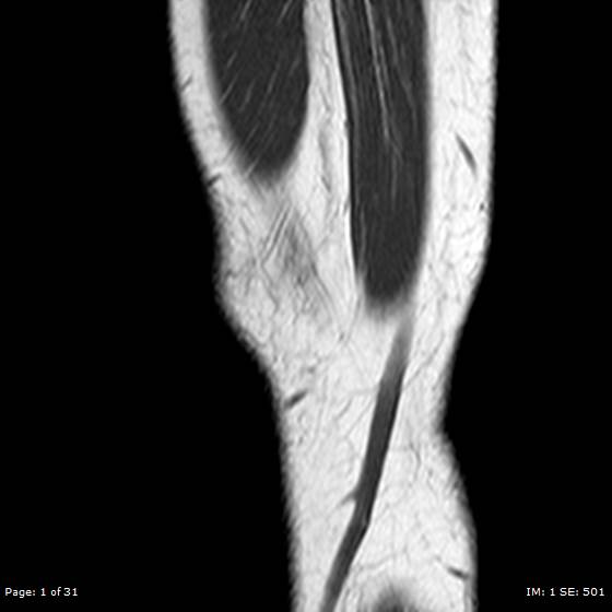 File:Anterior cruciate ligament tear (Radiopaedia 70783-80964 Sagittal T1 1).jpg
