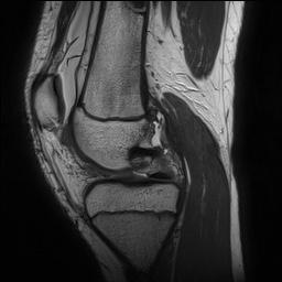 File:Anterior cruciate ligament tear - pediatric (Radiopaedia 62152-70260 Sagittal PD 71).jpg