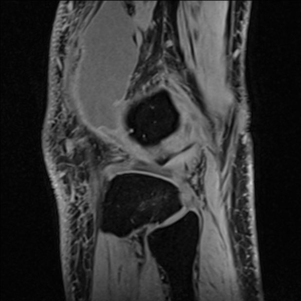 Anterior cruciate ligament tear - ramp lesion (Radiopaedia 71883-82322 Sagittal T1 vibe 26).jpg