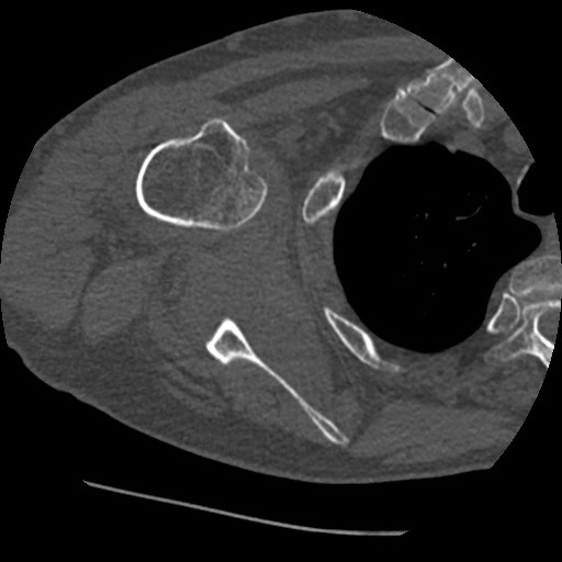 Anterior glenohumeral dislocation with Hill-Sachs lesion (Radiopaedia 62877-71249 Axial bone window 51).jpg