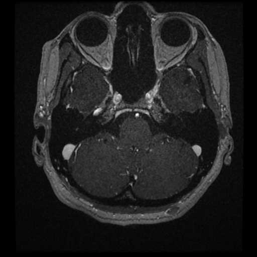 Anterior inferior cerebellar artery vascular loop - type II (Radiopaedia 70991-81209 Axial T1 C+ 58).jpg