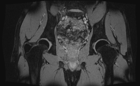 Anterior inferior iliac spine avulsion fracture (Radiopaedia 81312-95000 G 30).jpg