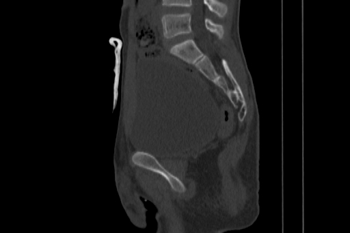 Anterior inferior iliac spine avulsion injury (Radiopaedia 88666-105376 Sagittal bone window 47).jpg