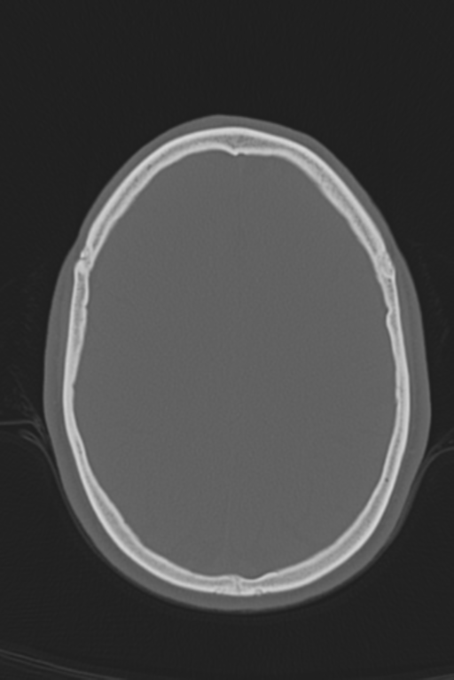 Anterior nasal spine fracture (Radiopaedia 46138-50494 Axial bone window 21).png