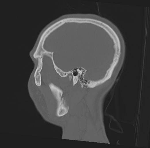 Anterior nasal spine fracture (Radiopaedia 46138-50494 Sagittal bone window 44).png