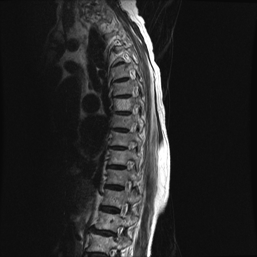 File:Anterior spinal artery syndrome (Radiopaedia 46335-50750 C 2).png