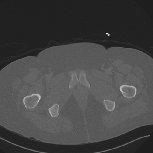File:Anterior superior iliac spine avulsion fracture (Radiopaedia 44541-48244 Axial bone window 103).png